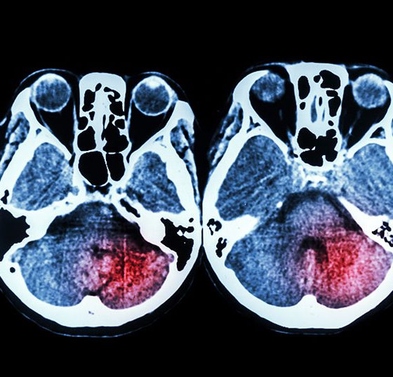 gehirn_mri_stroke_istock-475149924