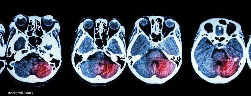 gehirn_mri_stroke_istock-475149924