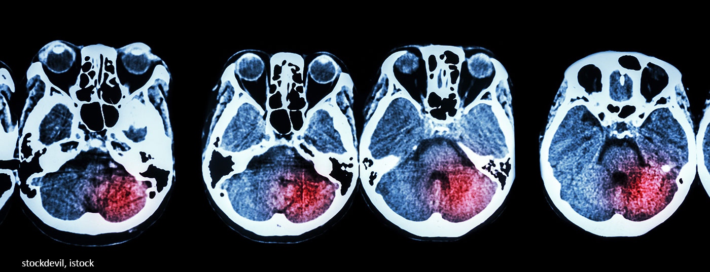 gehirn_mri_stroke_istock-475149924