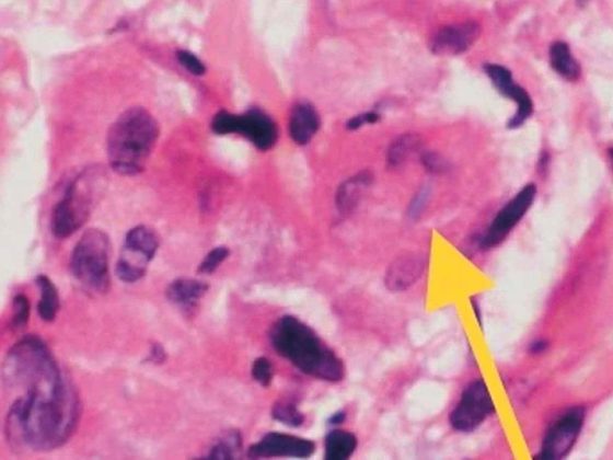 header_histopatho_elastophagozytose