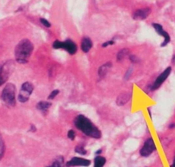 header_histopatho_elastophagozytose