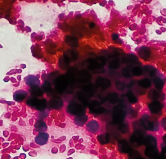 leberkrebs_istock-1353560976