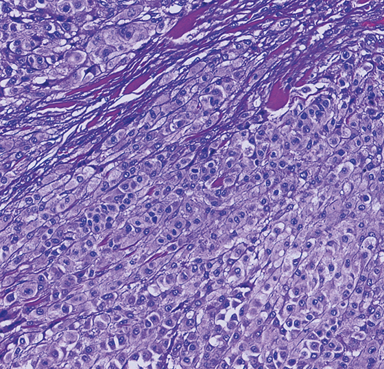 melanom_metastasierend_istock-1128205143