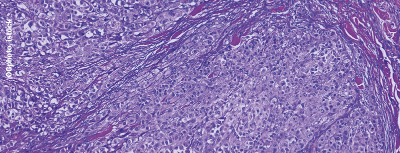 melanom_metastasierend_istock-1128205143