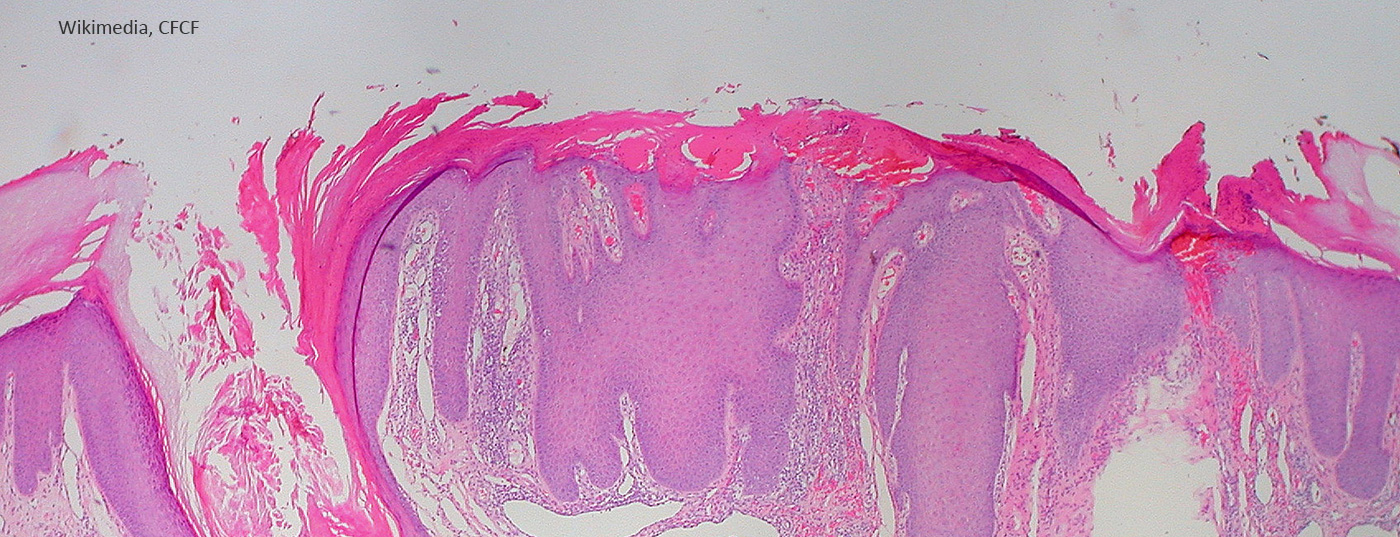 prurigo_nodularis_5078047877