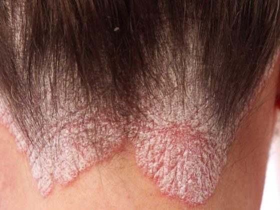 psoriasisnacken