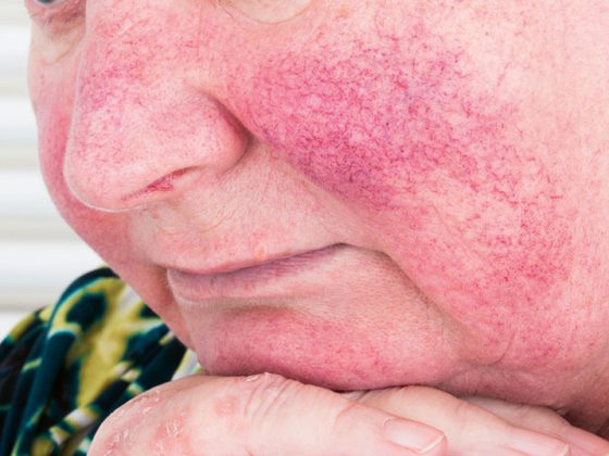 rosacea_istock-614739992