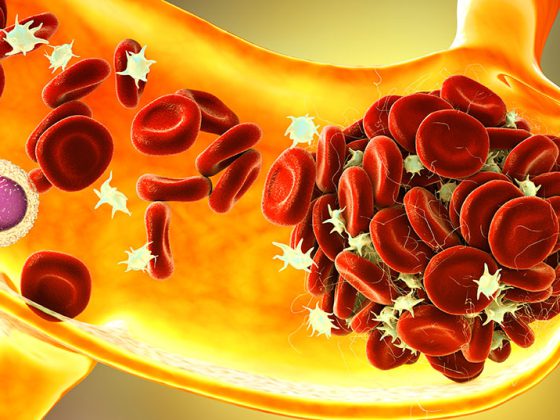 thromboembolie_istock-1349351825