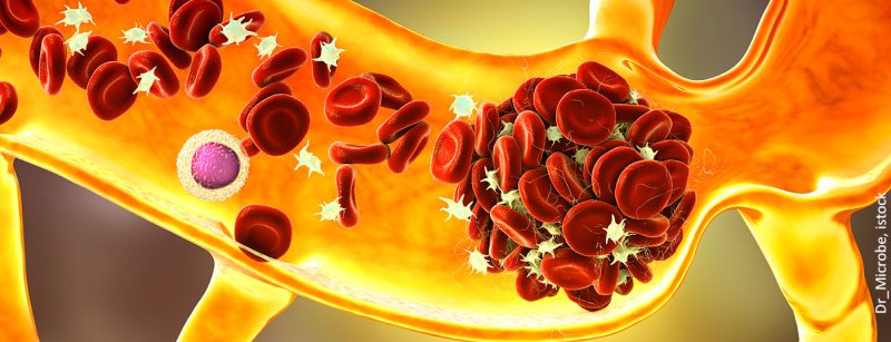 thromboembolie_istock-1349351825