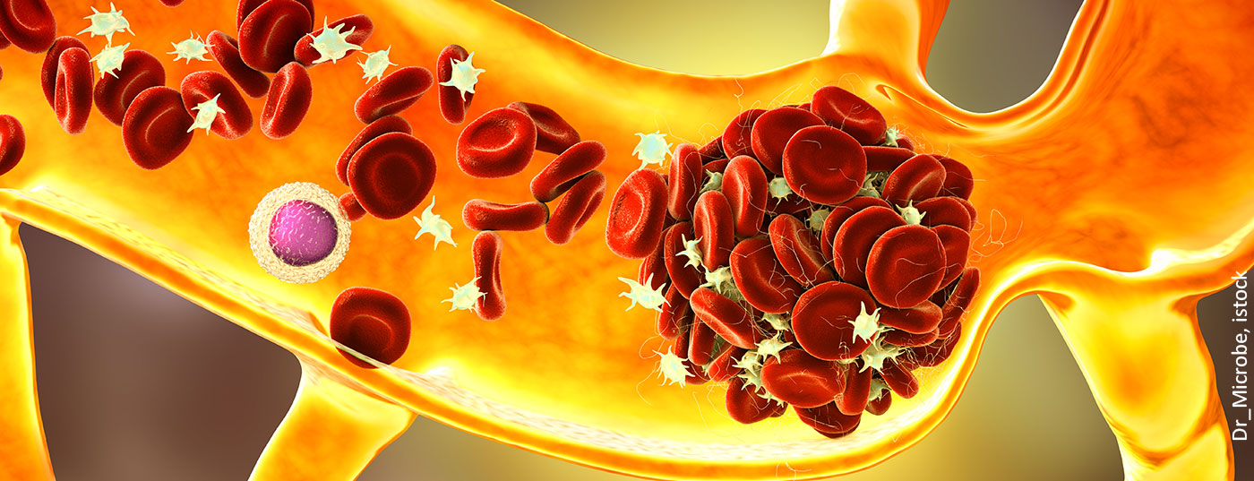 thromboembolie_istock-1349351825