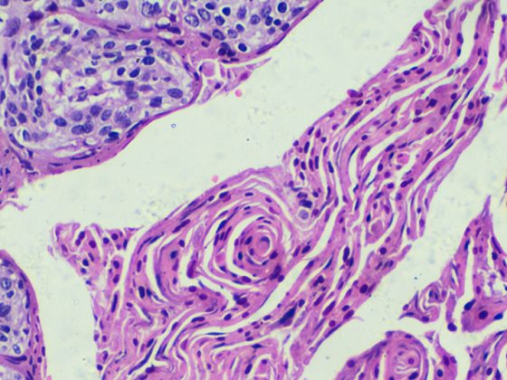 zervixkarzinom_istock-908134184