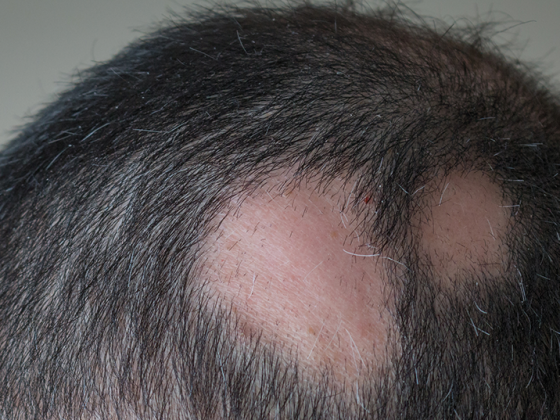 alopecie_istock-653778784