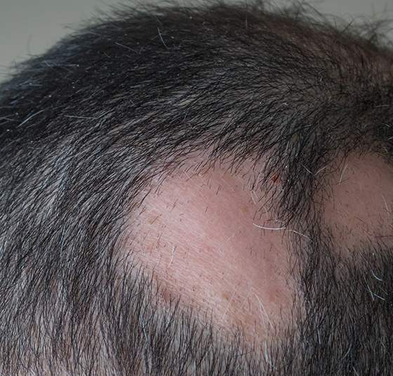 alopecie_istock-653778784