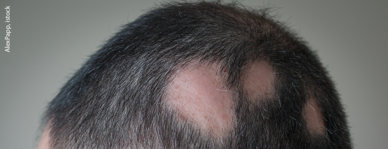 alopecie_istock-653778784