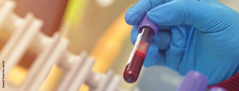 blutprobe_istock-1164063949