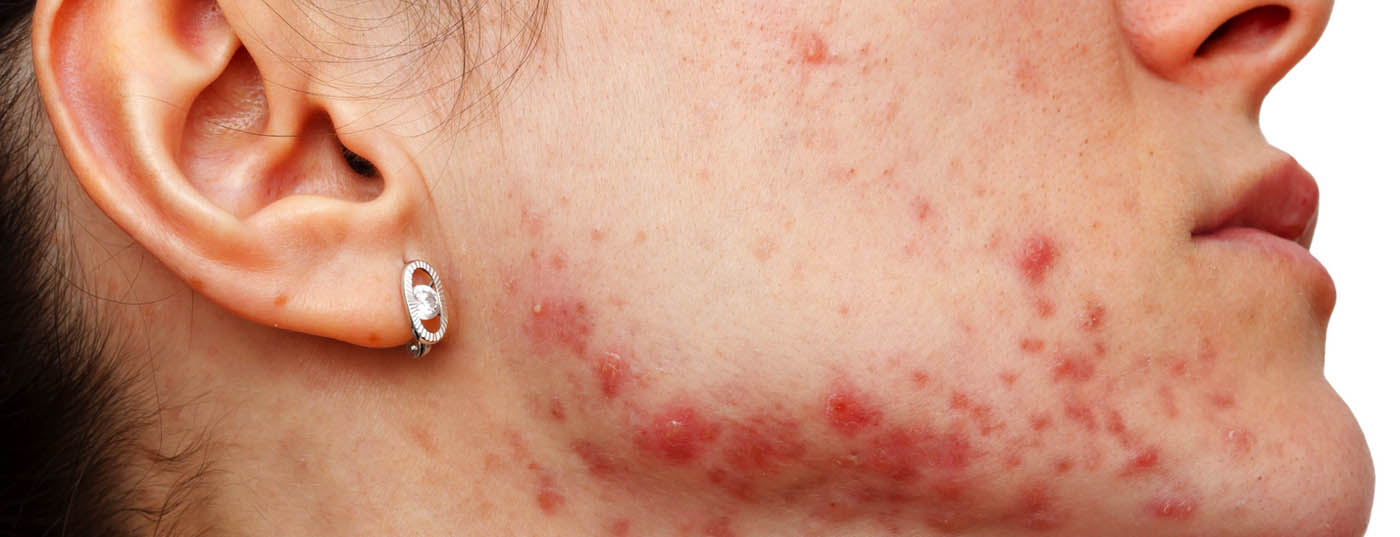akne