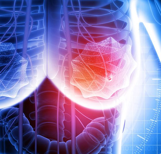 brustkrebs_istock-1273858064