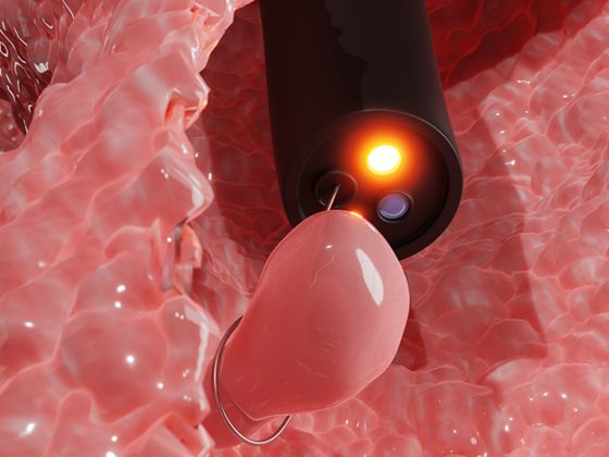 darmkrebs_koloskopie_istock-1322690771