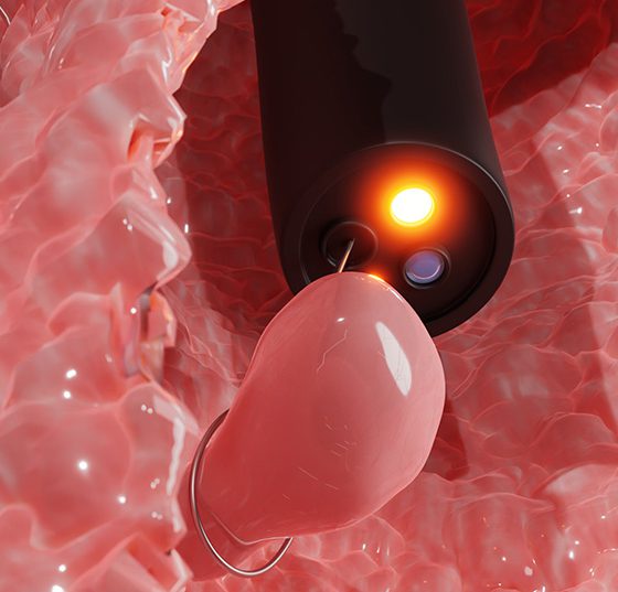 darmkrebs_koloskopie_istock-1322690771