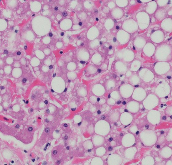 fettleber_istock-501623344