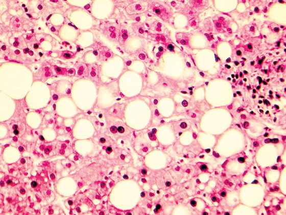 fettleber_istock-851075118