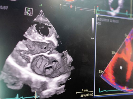 herz_kardiomyopathie_istock-1392693724