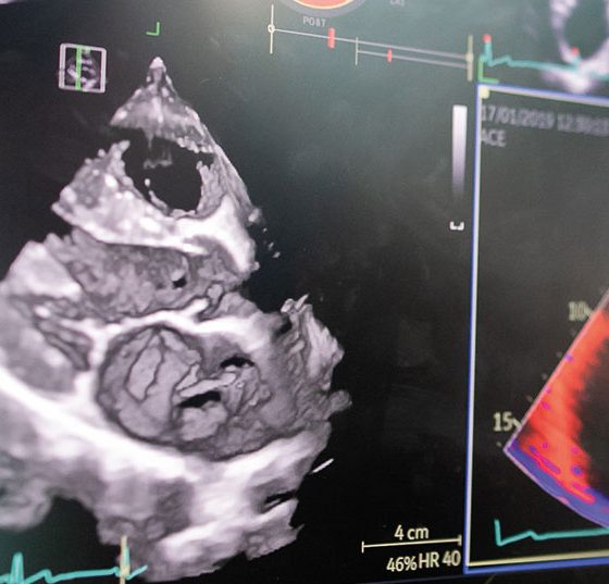 herz_kardiomyopathie_istock-1392693724