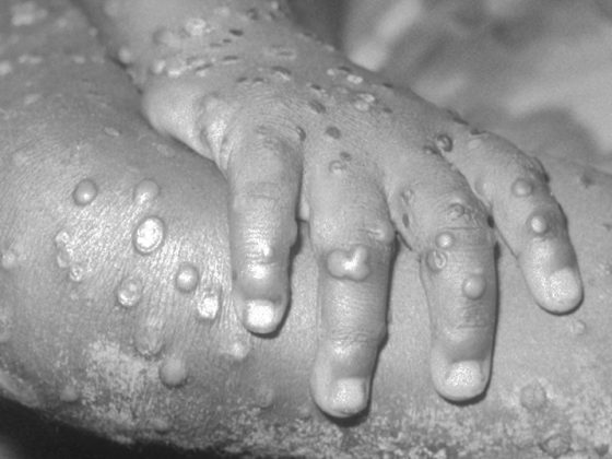 monkeypox_kopie