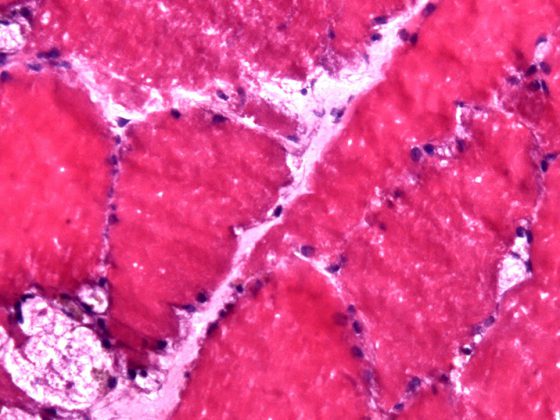 morbus_pompe_vacuoles