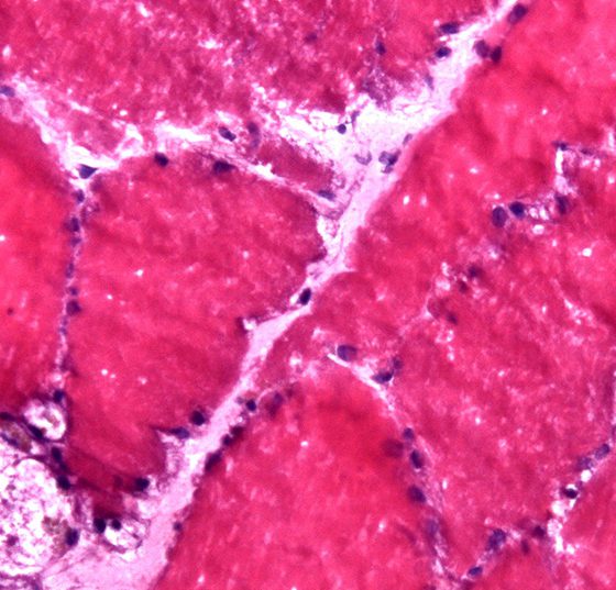 morbus_pompe_vacuoles