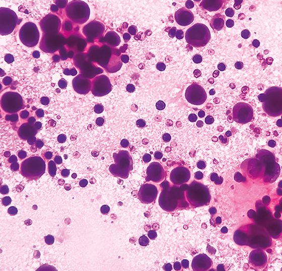 pleura_krebs_istock-1356302229