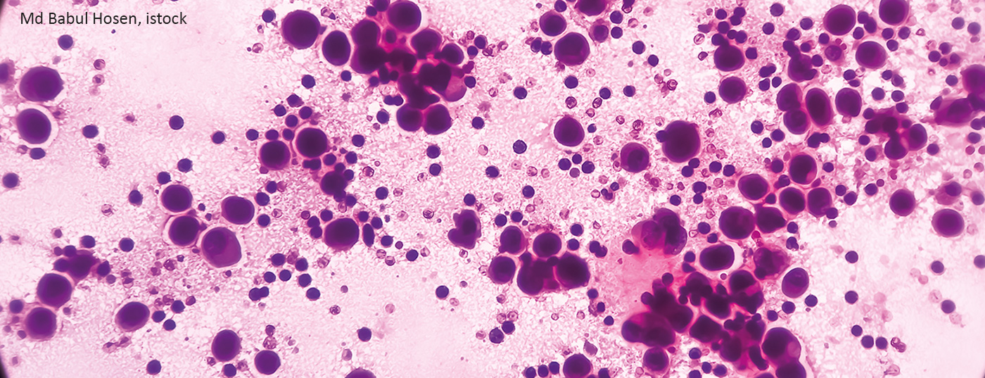 pleura_krebs_istock-1356302229