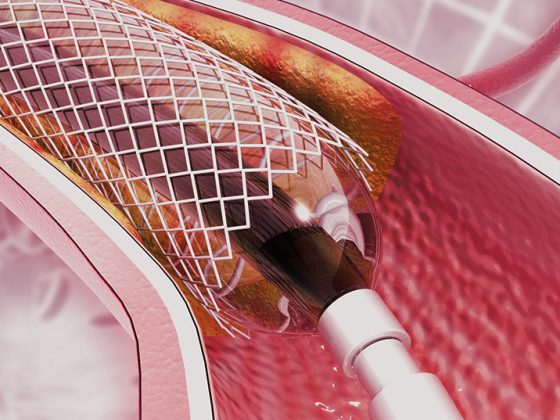 stent_istock-1183309129