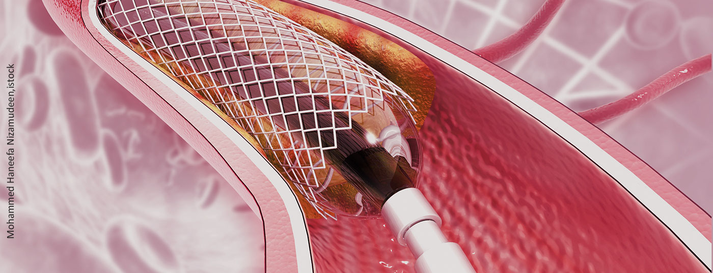 stent_istock-1183309129