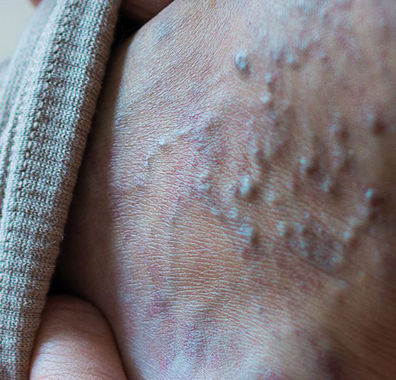 venen_krampfadern_istock-1220586701