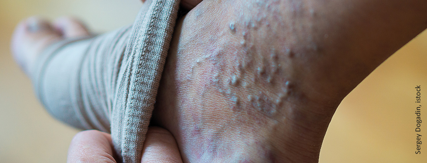 venen_krampfadern_istock-1220586701