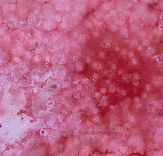 aktinischekeratose_wiki