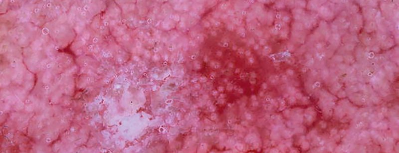 aktinischekeratose_wiki