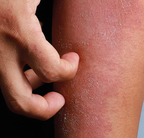 atopderma_istock-1270950737