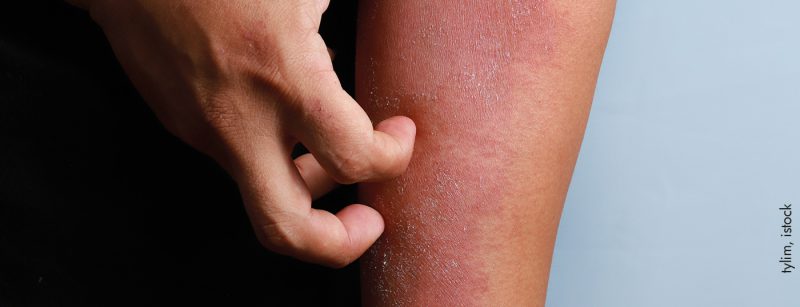 atopderma_istock-1270950737