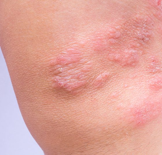atopische_derma_istock-1170007607