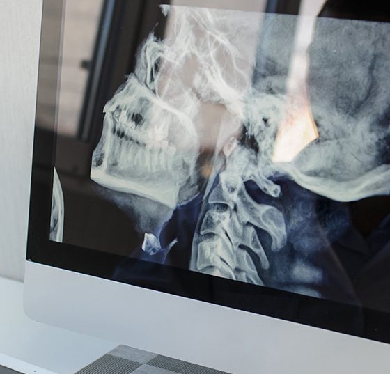 hals-nacken_istock-1353989116