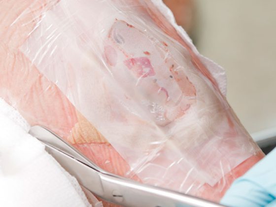 wunde_istock-171153394