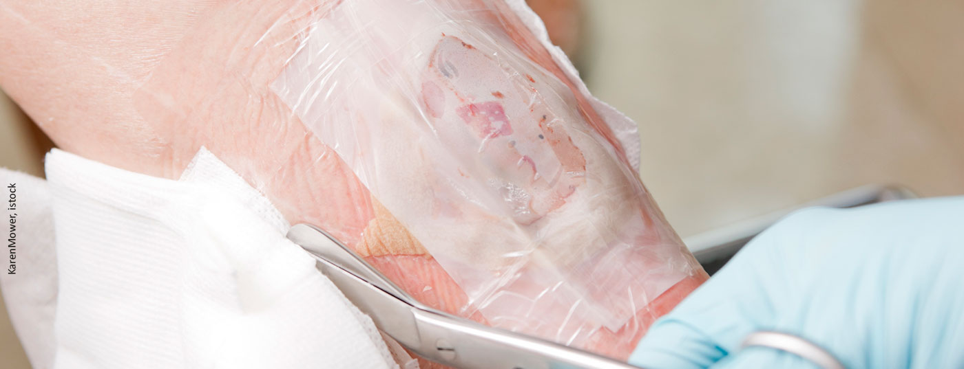 wunde_istock-171153394