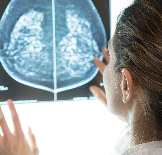 brustkrebs_istock-917730078