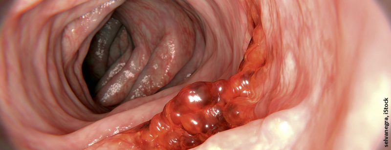 darmkrebs_istock-646161486