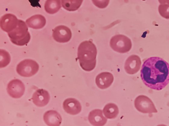 eisenmangel_istock-1379193688