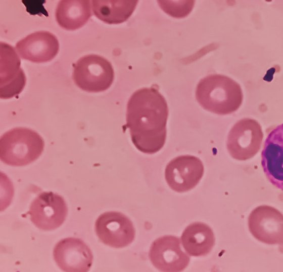 eisenmangel_istock-1379193688