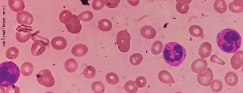 eisenmangel_istock-1379193688