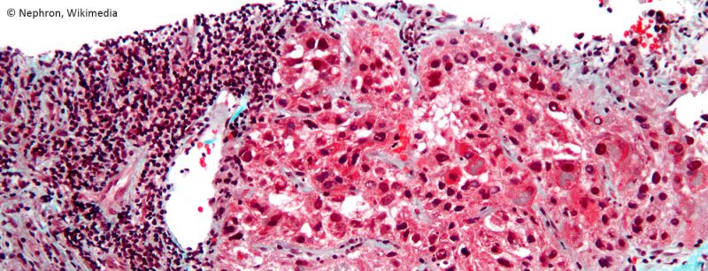hepatocellular_carcinoma_intermed_mag